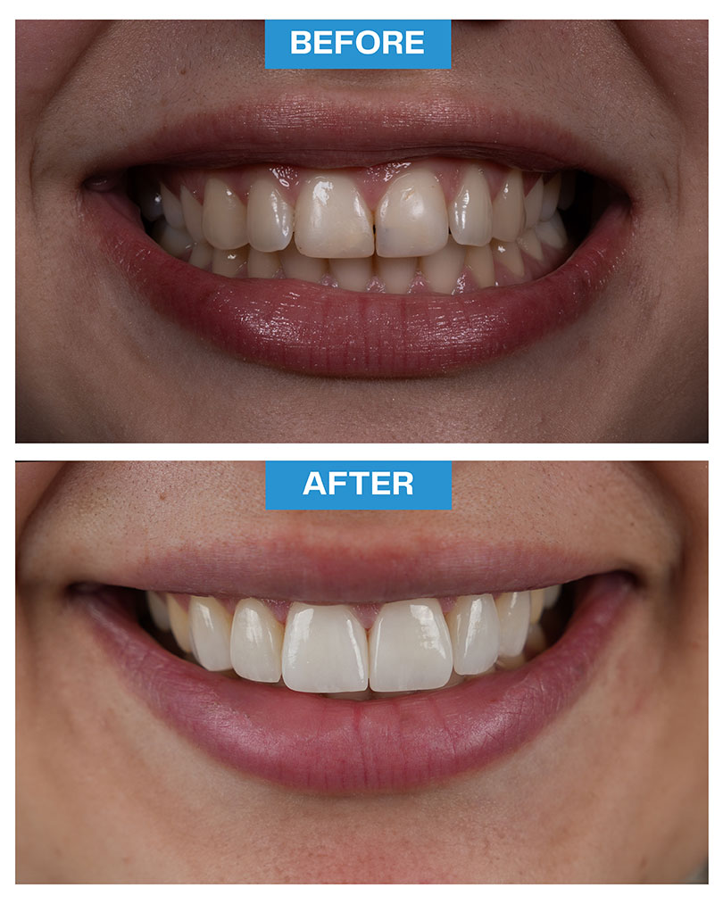 Veneers - Lumineers
