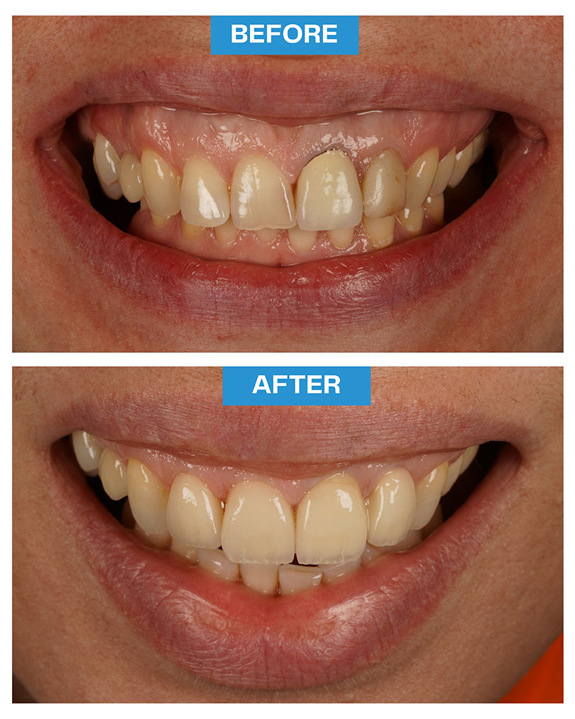 Veneers - Lumineers