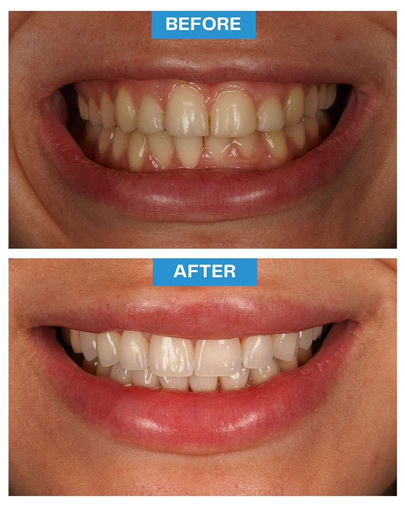 Veneers - Lumineers